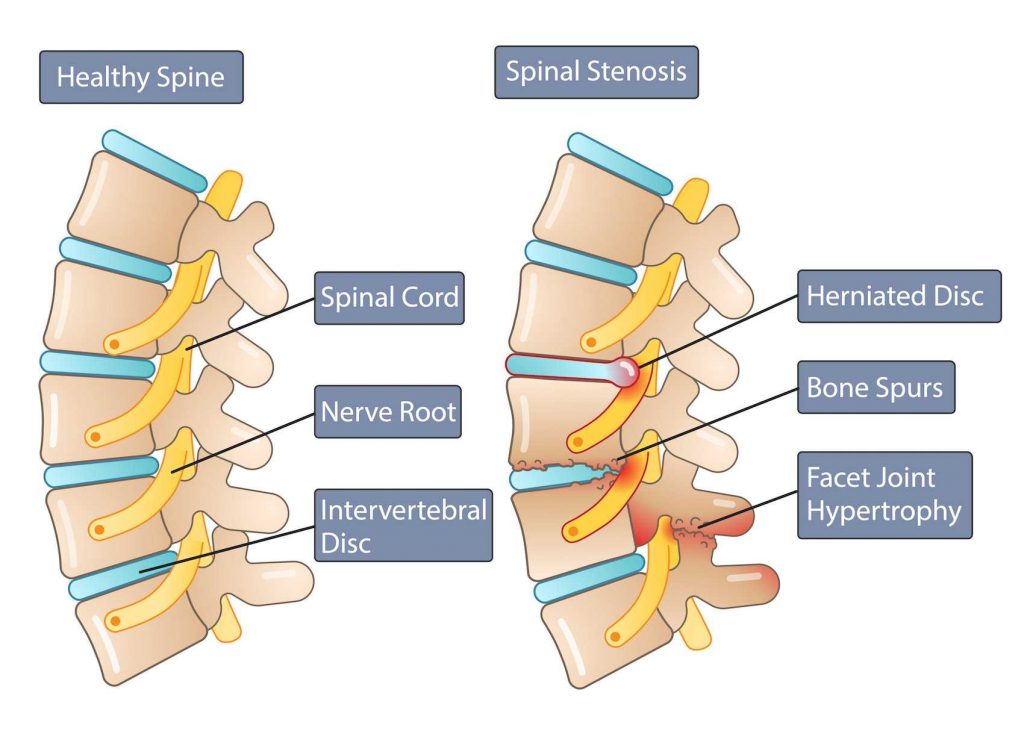 Back Pain & Sciatica: Causes, Symptoms, & Prevention – WorkFitME